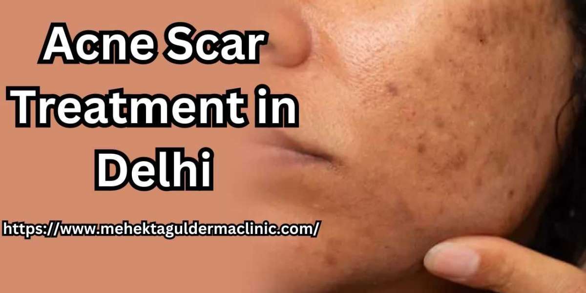 What are Acne Scars? How Can I Prevent Them?