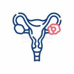 Ovarian Cancer Treatment