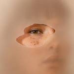 Eyelid Surgery in Riyadh