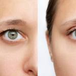 Eyelid Surgery in Riyadh