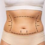 Lipo Abdonminoplasty in Riyadh