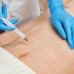 Gynecomastia Surgery in Riyadh