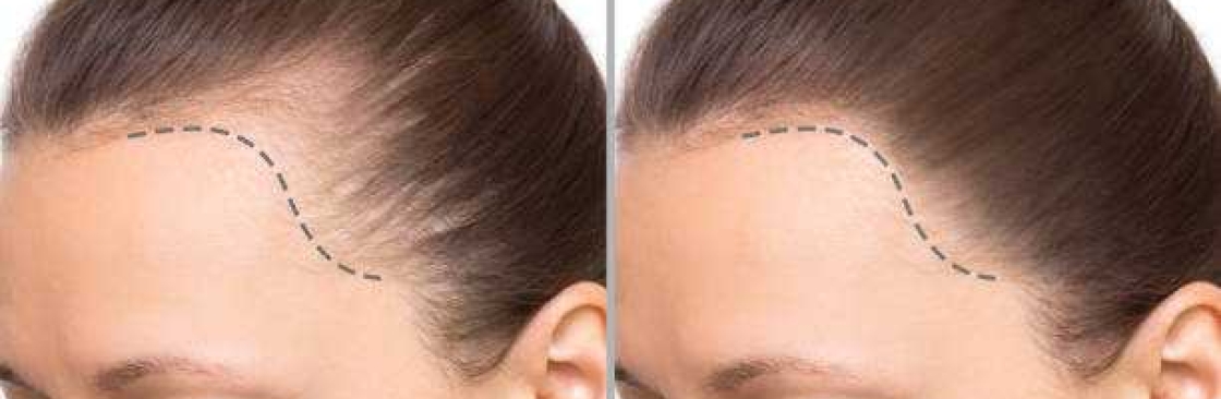 Hair Transplant in Riyadh Cover Image