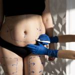 Tummy Tuck surgery in Riyadh