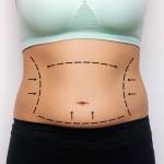 Lipo Abdonminoplasty Riyadh