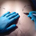 Gynecomastia Surgery in Riyadh