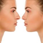 Rhinoplasty in Riyadh