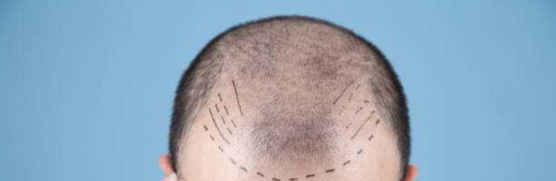 Hair Transplant in Riyadh Cover Image