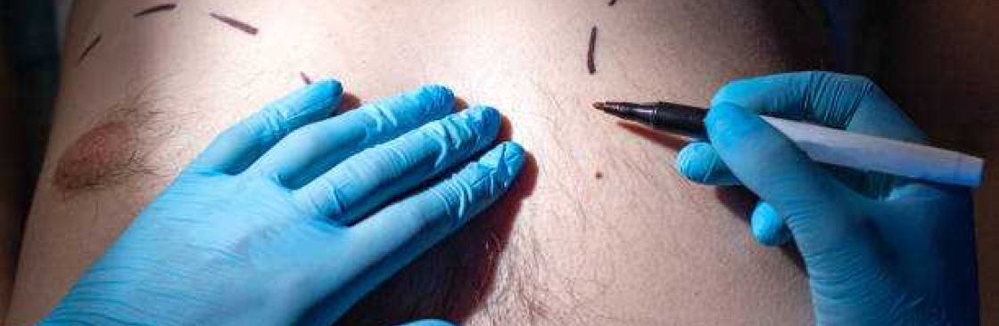 Gynecomastia Surgery in Riyadh Cover Image