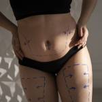 Tummy Tuck surgery in Riyadh