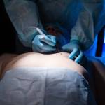 Gynecomastia Surgery in Riyadh