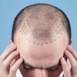 Hair transplant in Riyadh
