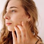 Acne Scar Treatment in Riyadh