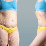 Liposuction in Riyadh