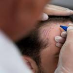PRP Hair Treatment in Riyadh