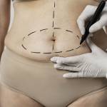 Tummy Tuck surgery in Riyadh